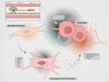 Grafik: So übertragen Krebszellen ihre Mitochondrien (grün) auf Bindegewebszellen