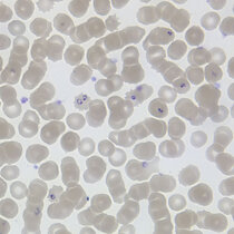 "Ringform" von Plasmodium falciparum in roten Blutzellen. 