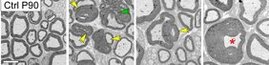 Ischias-Nerven von 3 Monate alten Mäusen im Querschnitt: Im Gegensatz zu Kontrolltieren (ganz links), weisen Tiere, denen das Rab35-Protein in den Schwann-Zellen fehlt, Demyelinisierung an Nervenfasern auf: Myelinausfaltungen (gelber Pfeil); Myelindegeneration (grüner Pfeil); "Tomacula" – fokale Myelinschichtverdickung (roter Stern). 