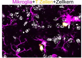 Mikroglia (magenta) - interagieren mit T Zellen (gelb) im zentralen Nervensystem von SPG15-defizienten Mäusen.