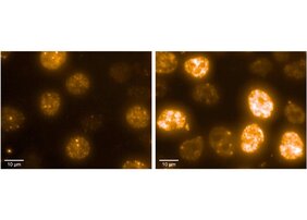 Neuroblastomzellen unter dem Mikroskop