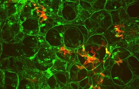 Tumorzelle im Labyrinth der Lungengefäße (bei Mäusen). Tumorzelle im Labyrinth der Lungengefäße (bei Mäusen).