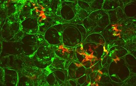 Tumorzelle im Labyrinth der Lungengefäße (bei Mäusen). Tumorzelle im Labyrinth der Lungengefäße (bei Mäusen).