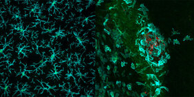 Hirntumor