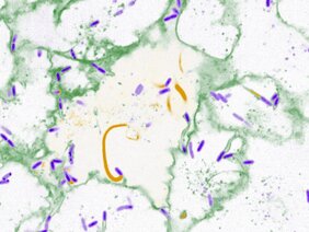 Der Erreger Burkholderia thailandensis (violett) verwendet Zellbestandteile (gelb), um die Membran von einer Wirtszelle (grün) in die benachbarte auszustülpen. 