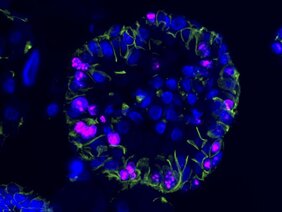 Menschliche ccRCC-Organoide unter dem Mikroskop, markiert mit fluoreszenten Farbstoffen. 