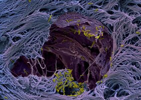 Der Krankenhauskeim Pseudomonas aeruginosa durchbricht die Abwehrlinie des Lungengewebes (Aufnahme im menschlichen Gewebemodell, vom Rasterelektronenmikroskop).