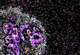 Ein Darmkrebsableger (linke Bildhälfte) in der Leber. In Magenta sind Darmkrebszellen zu sehen. Weiss darum herum sind andere Zellen innerhalb der Metastase 