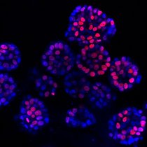 Leberkrebsorganoide unter dem Mikroskop: Die Zellkerne sind blau dargestellt, sich teilende Zellen rot. Leberkrebsorganoide unter dem Mikroskop: Die Zellkerne sind blau dargestellt, sich teilende Zellen rot.