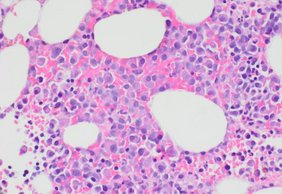 Multiple Myeloma  