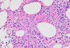 Multiple Myeloma  