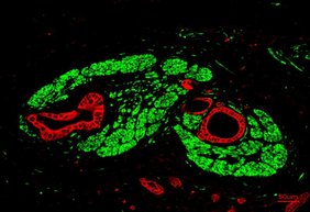 Bauchspeicheldrüsenkrebs in einer Immunofluoreszenz-Aufnahme: Die Tumorzellen sind rot, die von Tumorzellen befallenen Nerven grün markiert. 