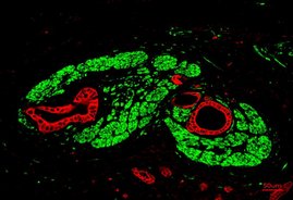 Bauchspeicheldrüsenkrebs in einer Immunofluoreszenz-Aufnahme: Die Tumorzellen sind rot, die von Tumorzellen befallenen Nerven grün markiert. 