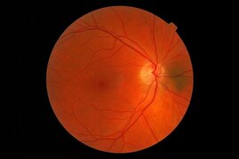 Retinitis pigmentosa führt zum Absterben der lichtempfindlichen Zellen der Netzhaut