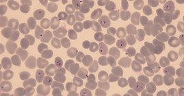 Mit Plasmodium falciparum infizierte rote Blutkörperchen  