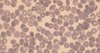 Mit Plasmodium falciparum infizierte rote Blutkörperchen  