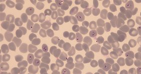 Mit Plasmodium falciparum infizierte rote Blutkörperchen  