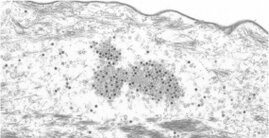 Papillomviren in der äußeren Hornhaut (Stratum corneum) eines Hauttumors einer Mastomys coucha