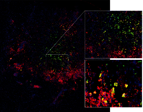 Mikroglia und Makrophagen wandern in einen Hirntumor ein und werden dabei umprogrammiert