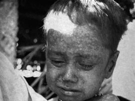Die zweijährige Rahima Banu aus Bangladesch war 1975 der letzte Mensch, der an Echten Pocken erkrankte 
