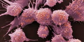 Prostatakrebszellen unter dem Elektronenmikroskop Prostatakrebszellen unter dem Elektronenmikroskop