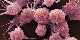 Prostatakrebszellen unter dem Elektronenmikroskop Prostatakrebszellen unter dem Elektronenmikroskop