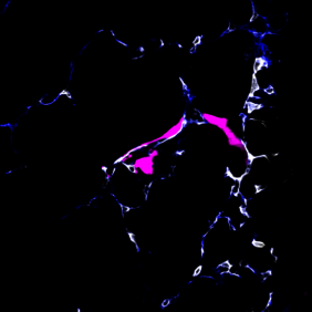 Metastasierende Krebszelle (pink) beim Verlasssen eines Blutgefäßes (Lunge) 