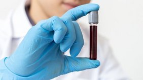 Neue Erkenntnisse zur Entstehung von Blutkrebs eine Hand hält ein Röhrchen mit Blut