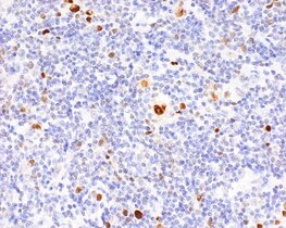 Hodgkin-Tumorzellen (hier IRF4-Färbung in braun) sind sehr groß 