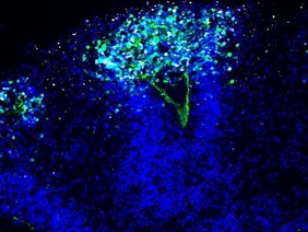 Herpes-Enzephalitis mit Mini-Hirnen