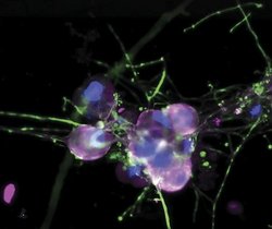 Die Aufnahme zeigt generierte patienteneigene Nervenzellen in grün. Der Zellkern ist bau dargestellt und der TRPA1 Kanal in Magenta.