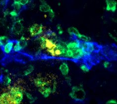 Die Blutgefäße innerhalb einer Leber-Metastase sind blau eingefärbt, T-Zellen grün. Die Blutgefäße innerhalb einer Leber-Metastase sind blau eingefärbt, T-Zellen grün.