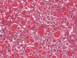 Histologischer Schnitt einer Schilddrüsengewebeprobe aus dem GTEx-Portal. Histologischer Schnitt einer Schilddrüsengewebeprobe