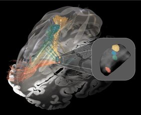 Betroffene Nervenbündel bei Parkinson-Syndrom (grün), Dystonie (gelb), Tourette-Syndrom (blau) und Zwangsstörung (rot)