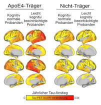 ApoE4-Träger zeigen eine stärkere Amyloid-abhängige Zunahme der Tau-Eiweiße im Gehirn als Träger anderer ApoE-Varianten.