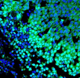 Immunfluoreszenzbild eines basalen Brusttumors