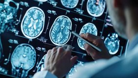 Frühe Immun- und Synapsenveränderungen bei Parkinson entdeckt Hirnscanns