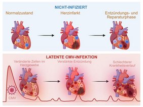 Eine latente Cytomegalievirus-Infektion verändert das Immunmilieu des Herzens dauerhaft. AI-Grafik Eine latente Cytomegalievirus-Infektion verändert das Immunmilieu des Herzens dauerhaft.