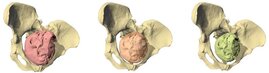 Geburtssimulation von Lucy (Australopithecus afarensis) mit drei unterschiedlich grossen Fetuskopfgrössen