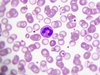 Neutrophile gelten als Mitverursacher von Thrombosen. 