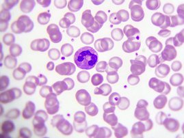 Neutrophile gelten als Mitverursacher von Thrombosen. 