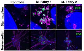 Die Abbildung zeigt die für Morbus Fabry charakteristischen Sphingolipidablagerungen in patienteneigenen Stammzellen und Nervenzellen