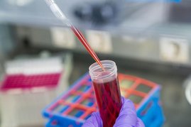 Für das neue, nicht invasive Diagnostikverfahren wird zellfreie DNA aus dem Blut von Patienten isoliert. Für das neue, nicht invasive Diagnostikverfahren wird zellfreie DNA aus dem Blut von Patienten isoliert.