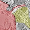 Elektronenmikroskopische Aufnahme eines SCLC-Allotransplantats aus einem Mäusegehirn