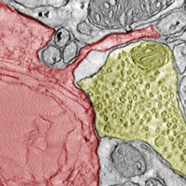 Elektronenmikroskopische Aufnahme eines SCLC-Allotransplantats aus einem Mäusegehirn