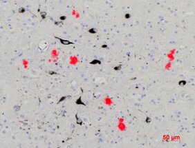 Hirngewebe einer Maus mit Alzheimer-ähnlichen Symptomen. Beta-Amyloid-Plaques