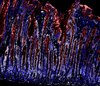 Magenschleimhaut nach Infektion mit H. pylori.