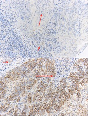 Immunhistochemische Färbung von ATP5B für HPV-negative (oben) und HPV16-positive (unten) Oropharynxkarzinome 