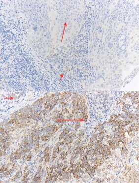 Immunhistochemische Färbung von ATP5B für HPV-negative (oben) und HPV16-positive (unten) Oropharynxkarzinome 