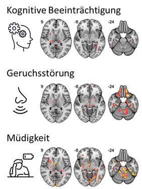 MRT-Bildre von Gehirnen mit Covid Schäden